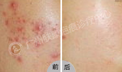 广州肤康皮肤病医院