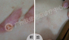 广州肤康皮肤病医院