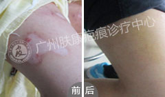 广州肤康皮肤病医院