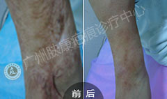 广州肤康皮肤病医院