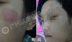 广州肤康皮肤病医院