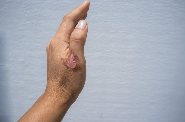 广州肤康皮肤病医院